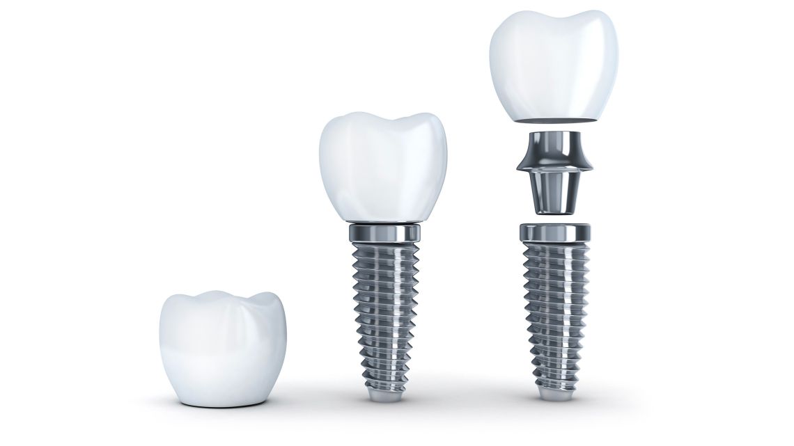 Dental Implants Event